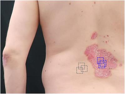 Case report: Optical coherence tomography for monitoring biologic therapy in psoriasis and atopic dermatitis